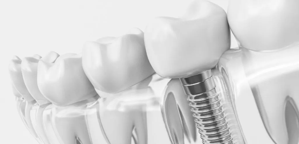 dental implants