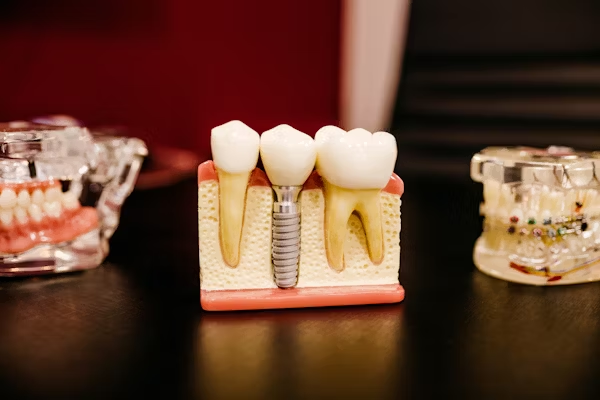 a dental model with a dental implant