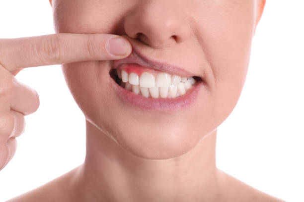 close-up shot of a person's mouth with red gums