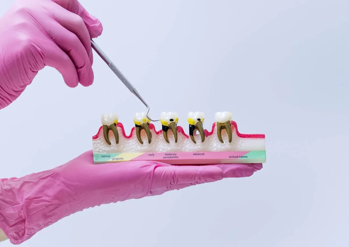 Dental model showing stages of plaque buildup and gum disease affecting teeth.